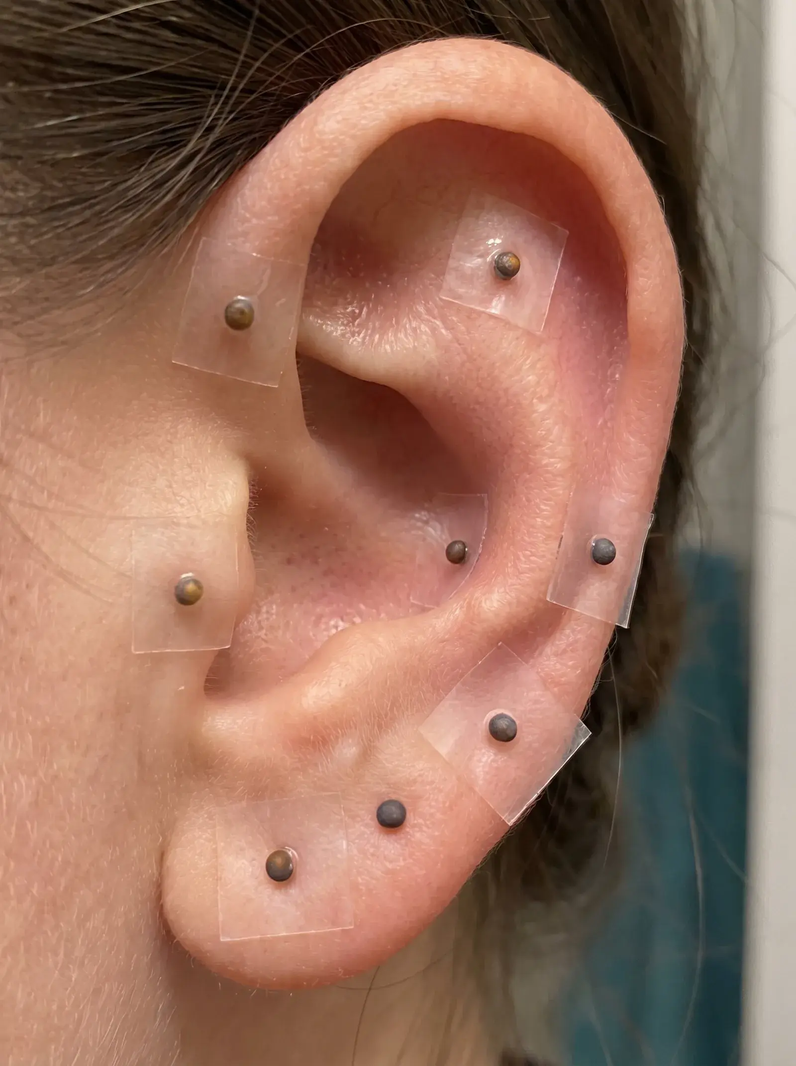 Auriculoterapia