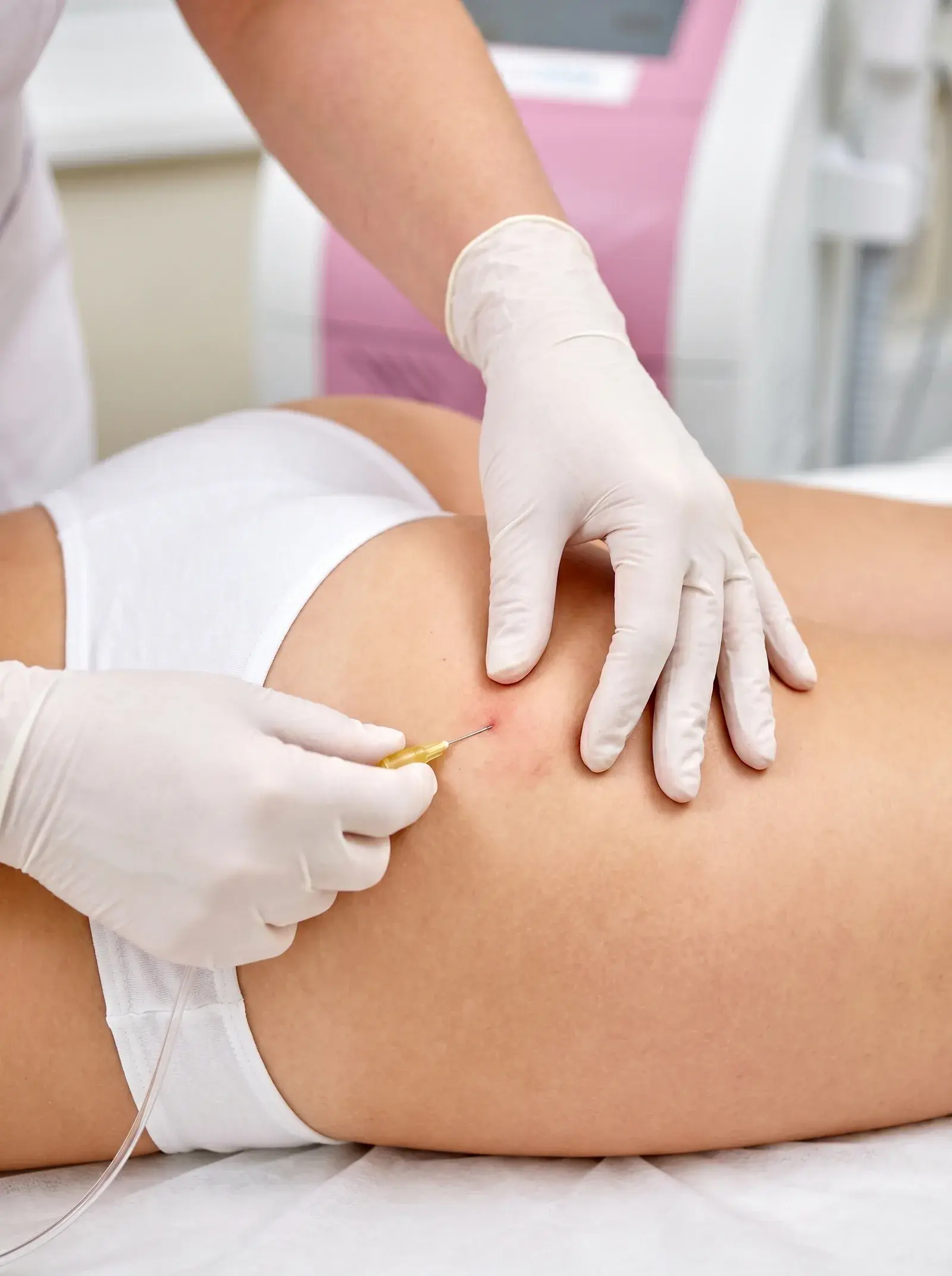 Carboxiterapia
