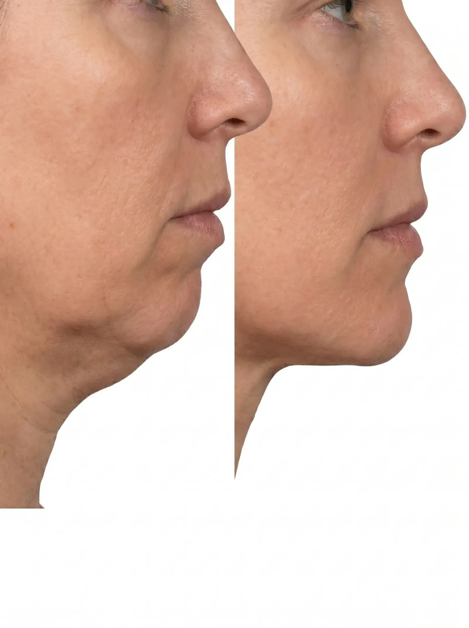 Lipo de Papada